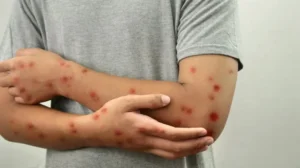 mpox-cases-in-pakistan-show-signs-of-local-transmission