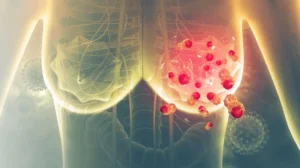 new-ultrasound-therapy-can-kill-breast-cancer-in-pakistani-patients-without-surgery