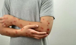 another-mpox-case-confirmed-in-karachi