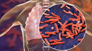 rs-1100-portable-device-can-detect-tb-within-30-minutes-in-pakistan