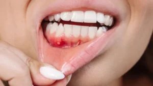 mouth-cancer-cases-rising-rapidly-in-karachi-and-across-sindh