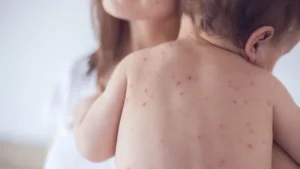 measles-and-diphtheria-claim-lives-of-144-children-in-karachi-in-2026